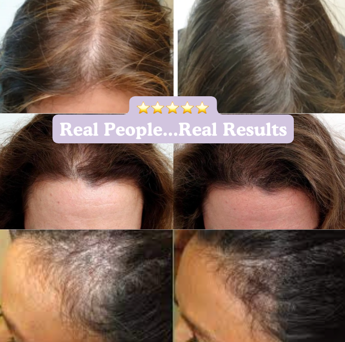 NEW Rootz™ 2.0 : Anion Therapy scalp massager